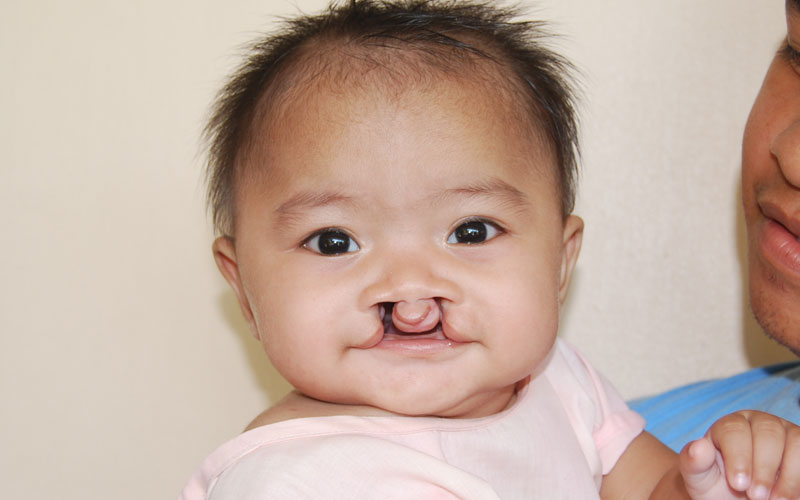 bilateral cleft palate